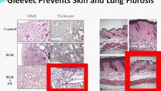 Webinar: Accelerating Scleroderma Research Toward a Cure, with Dr. John Varga (2012)