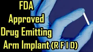 New FDA Approved Arm Implant To Treat Opioid And Heroin Dependence