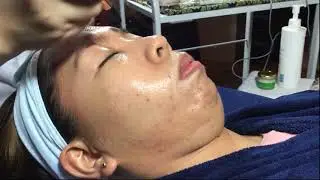 BDR Treatment Demo Bioessence SM Dasmarinas Branch