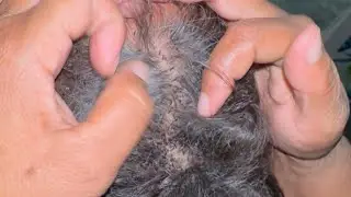 #licesremoval 🔥Head Lice Treatment – Wife Removes Lice from Husband | Love vs Lice EP 117🐜💇‍♀️