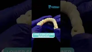 Affordable Lower Screw Retained Prosthetic at Dr Richa&rsquo;s Cosmodent Durable & Precision-Fit Solution