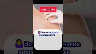Диагностика заболеваний по внешним признакам👌. АНГИОМА.