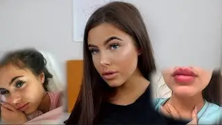 MY LIP INJECTION EXPERIENCE