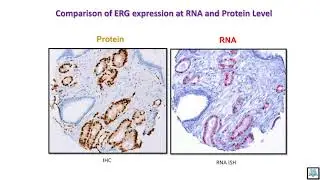 Combined immunohistochemistry and RNA in situ hybridization to elucidate tumor ...