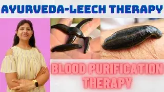 Leech Therapy - Ayurveda Bloodletting method, Raktamokshana method - Jalaukavacharana