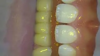 Front tooth composite restoration part1