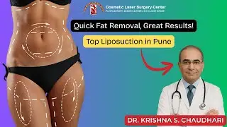 Liposuction in Pune | Cost, Results, VASER & Laser Fat Removal Explained by Dr. Krishna Chaudhari