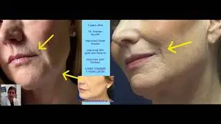 Dr. Suzman leading NY Plastic Surgeon shows how his facelift result evolves over 5 years