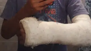 Como eu quebri o bra&ccedil;o?