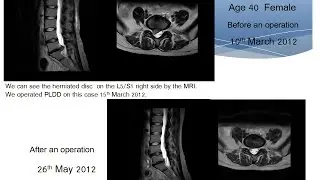PLDD surgery for herniated disc MeguroYuaiClinic