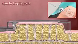 Cellfina Module 1 Animation vf FINAL mp4