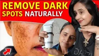 How to Remove Dark Spots & Pigmentation & Get Clear Skin with 7 Days Natural Dark Spot Cream