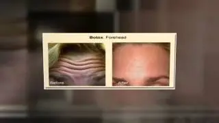 Dunedin Botox Tampa Bay Ultimate Image 727 799 7000