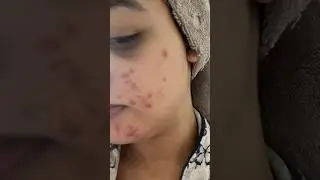 6 meses e meio de roacutan #roacutan #acne #isotretinoina