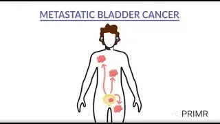 Bladder Cancer Clinical Trial - IMMORTAL Trial