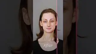 ✨ Lydia beautiful 𝐢𝐧𝐦𝐞𝐝𝐢𝐚𝐭𝐞 𝐩𝐨𝐬𝐭-𝐨𝐩 𝐫𝐞𝐬𝐮𝐥𝐭𝐬 of her #FacialFeminizationSurgery