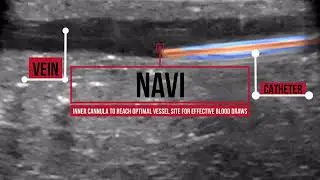 Navi needle-free blood draw device. Yes you heard right! Our engineers designed a dev...