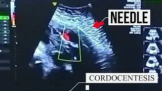 Cordocentesis procedure DONE AT GLOBAL ULTRASOUND