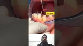 Daat ka kida! 😱Tooth pulp 😍#shorts