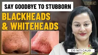 Blackheads & Whiteheads Explained | Causes, Mistakes & Safe Treatments by Dermatologist | Niti Gaur