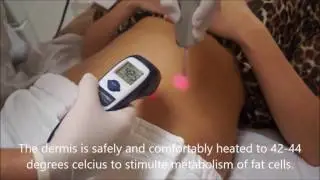 Fotona TightSculpting | Dr. Shel Wellness & Aesthetic Center