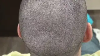 FUE Donor Scar 1 Year Follow Up San Francisco Hair Loss Dr. Diep www.mhtaclinic.com