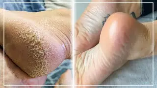 TRANSFORMER DES PIEDS TR&Egrave;S SECS EN PIEDS DE B&Eacute;B&Eacute;