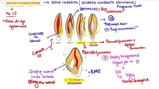 Oehlers Classification of Dens In Dente ORAL PATHOLOGY