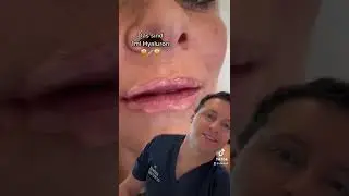 HYALURON LIPPEN👄 &ndash; so viel ist 1ml &ndash; Dr. Rolf Bartsch #shorts #hyaluron #lippen