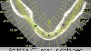 CT Scan-Guided Dental Implant Planning