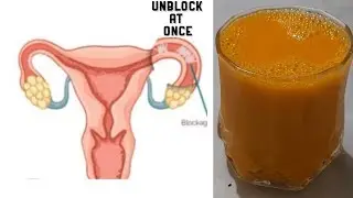 NATURAL WAY TO UNBLOCK A BLOCKED FALLOPIAN TUBE.