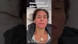 Microneedling RF | After Treatment Look | Micro RF