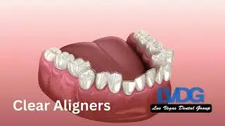 How Clear Aligners Work Las Vegas Dental Group Aligners Near Me #aligners #alignersnearme