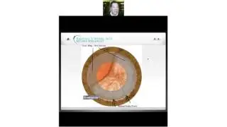 Treatment for Floaters Webinar April 24 2017 | Randall Wong MD