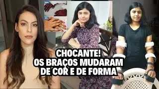 Transplantaram braços masculinos nela, e o que aconteceu chocou os médicos!