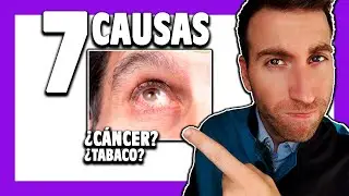 🟪 &iquest;Qu&eacute; es la UVE&Iacute;TIS ocular? Causas y consecuencias [Cap. 1]