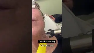 See Why Laser Skin Resurfacing Is So Popular For Aging Skin