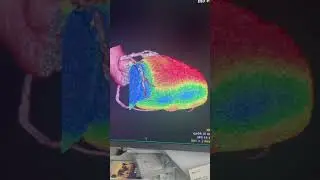 SPECT/CT fusion imaging - distal LCX CTO (Fixed)