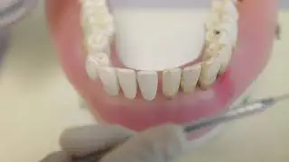 [Periodontal Examination Series] 11. Tooth Mobility (Miller Classification 1950)