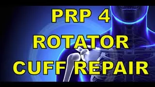 Using PRP for a labrum tear, rotator cuff tear and osteoarthritis of the shoulder.