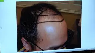 Asian Hairline Lowering via Hair Transplant Surgery (Before/After Included) by Dr. Diep