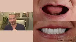 Cosa sono gli impianti pterigoidei e come si effettuano - Studio Dentistico Cannizzo
