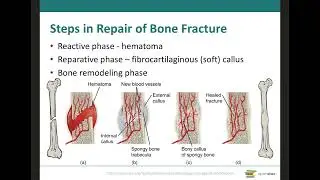 A&P I Module 4 LO9 Bone Fracture Classification and Bone Repair