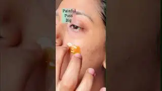 Bar-Bar Pimples Aa Rahe Hain? Ye 3 Cheezein Try Karo🔥 #pimple #homeremedies #skincare #pimpleproblem