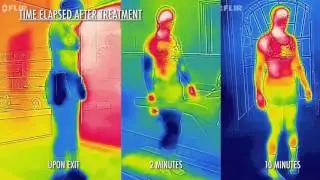 US Cryotherapy Thermal Video