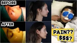 ОБСЛУЖИВАНИЕ ПЕРЕД РИСОФТОЙ: СТОИМОСТЬ, ВОССТАНОВЛЕНИЕ, БОЛЬ (ДО И ПОСЛЕ)