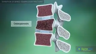 Spinal Compression fractures Definition