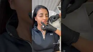 DISSOLVING LIP FILLER