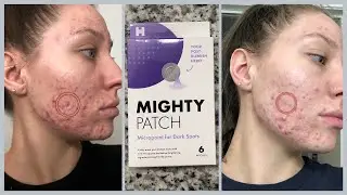 Using Micropoint for Dark Spots?? Lets Put It To The Test | Mighty Patch |