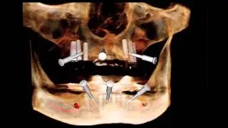 Prettau Full Mouth Dental Implants ~3D planning by Ramsey Amin DDS